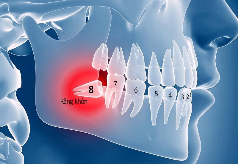 Những điều cần biết về nhổ răng khôn 6