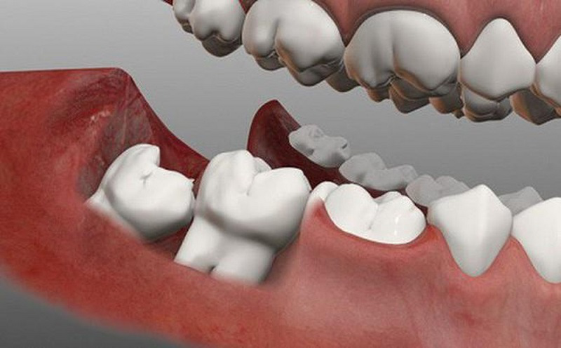 Những điều cần biết về nhổ răng khôn 1