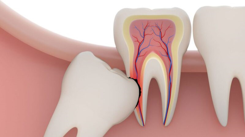 Những điều cần biết về nhổ răng khôn mọc lệch 5
