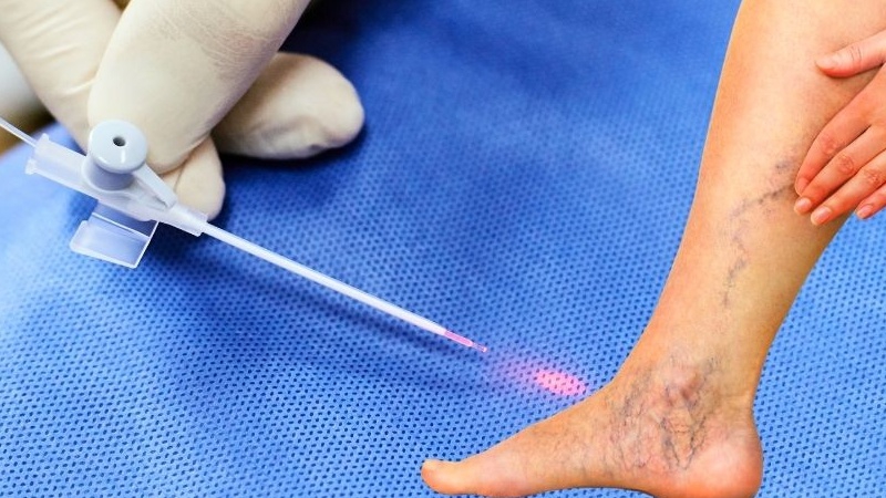 Những thông tin quan trọng bạn cần biết về phương pháp laser tĩnh mạch