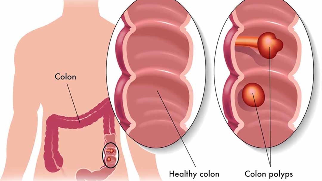 Những thông tin về hội chứng Polyp Juvenile