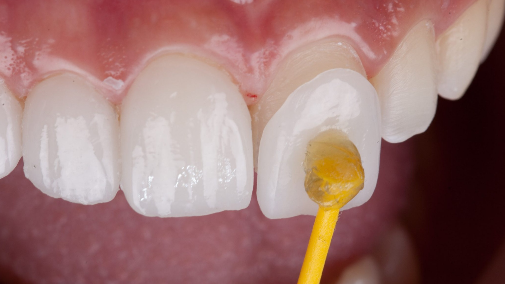 Dán răng sứ có gây đau, ê buốt hoặc kích ứng nướu không?