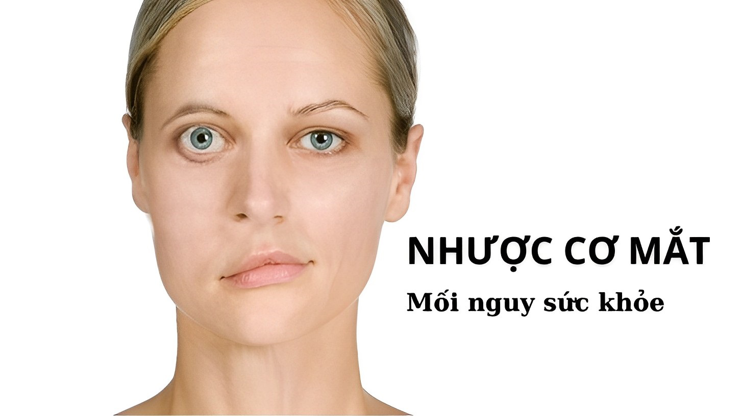 Bệnh Nhược Cơ Mắt