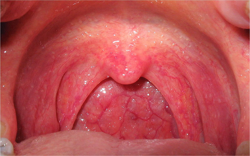 Nổi cục màu trắng trong miệng là bị bệnh gì: Nguyên nhân và cách xử lý 4