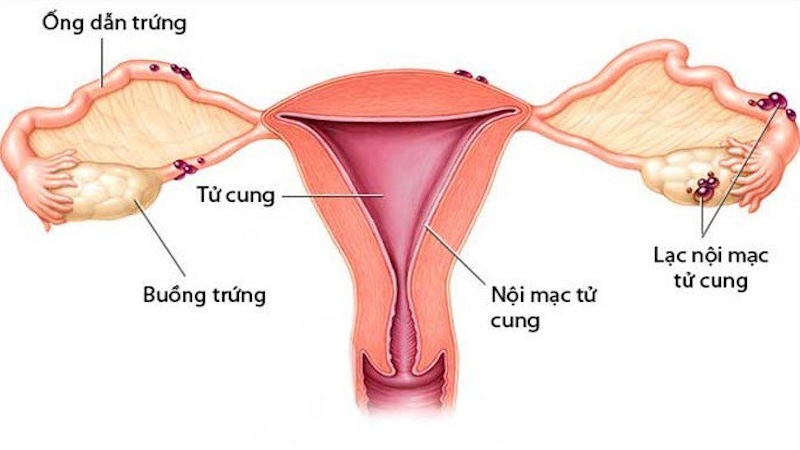 Nội mạc tử cung dày báo hiệu bệnh gì?