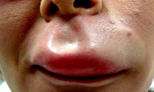Tại sao sưng môi nổi mề đay gây cảm giác ngứa ngáy và khó chịu?
