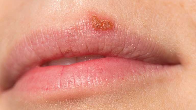Herpes miệng | G3VN