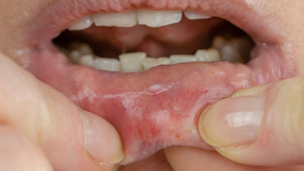 Những nguyên nhân gây ra mụn nước trong miệng là gì?
