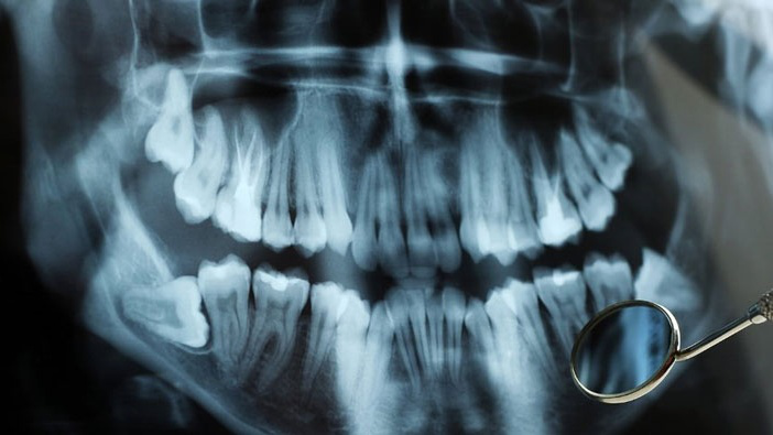 Nong hàm trong niềng răng là gì? Tìm hiểu về kỹ thuật nong hàm 3