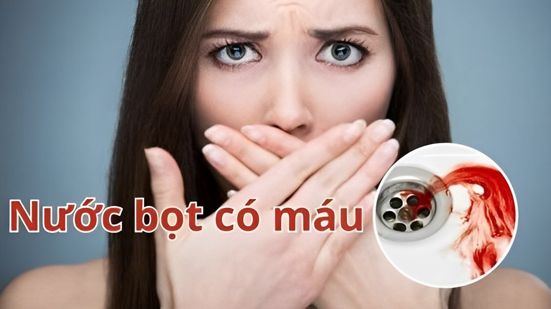 Nước bọt có máu là triệu chứng của bệnh gì?