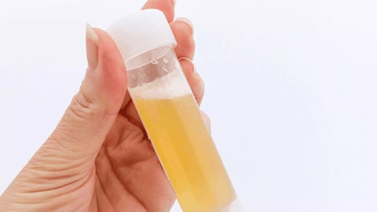 Nước tiểu có bọt là triệu chứng bệnh gì? Có nguy hiểm không?