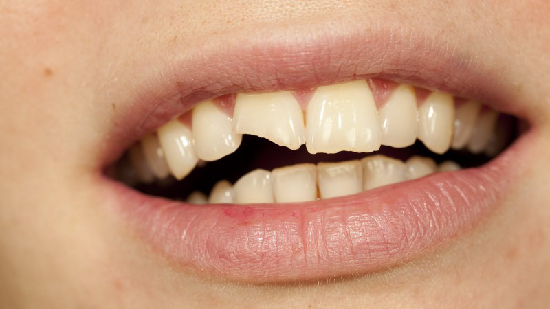Nứt răng cửa có nguy hiểm không và cách nhận biết 2