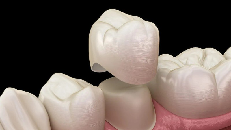 Nứt răng cửa có nguy hiểm không và cách nhận biết 4