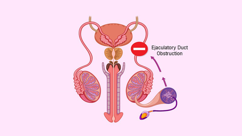 Ống phóng tinh: Cấu tạo, chức năng và bệnh lý phổ biến nhất 2