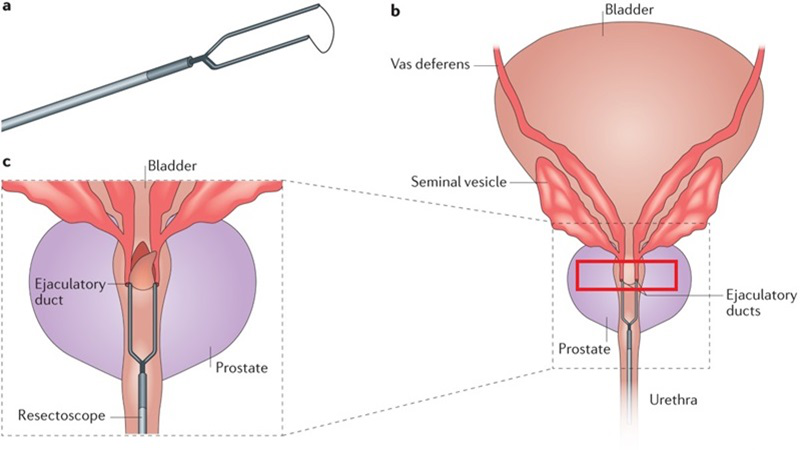 Ống phóng tinh: Cấu tạo, chức năng và bệnh lý phổ biến nhất 4