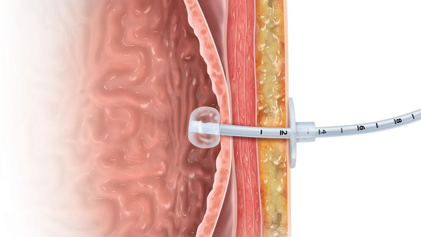 Tìm hiểu chi tiết về thủ thuật đặt ống thông dạ dày