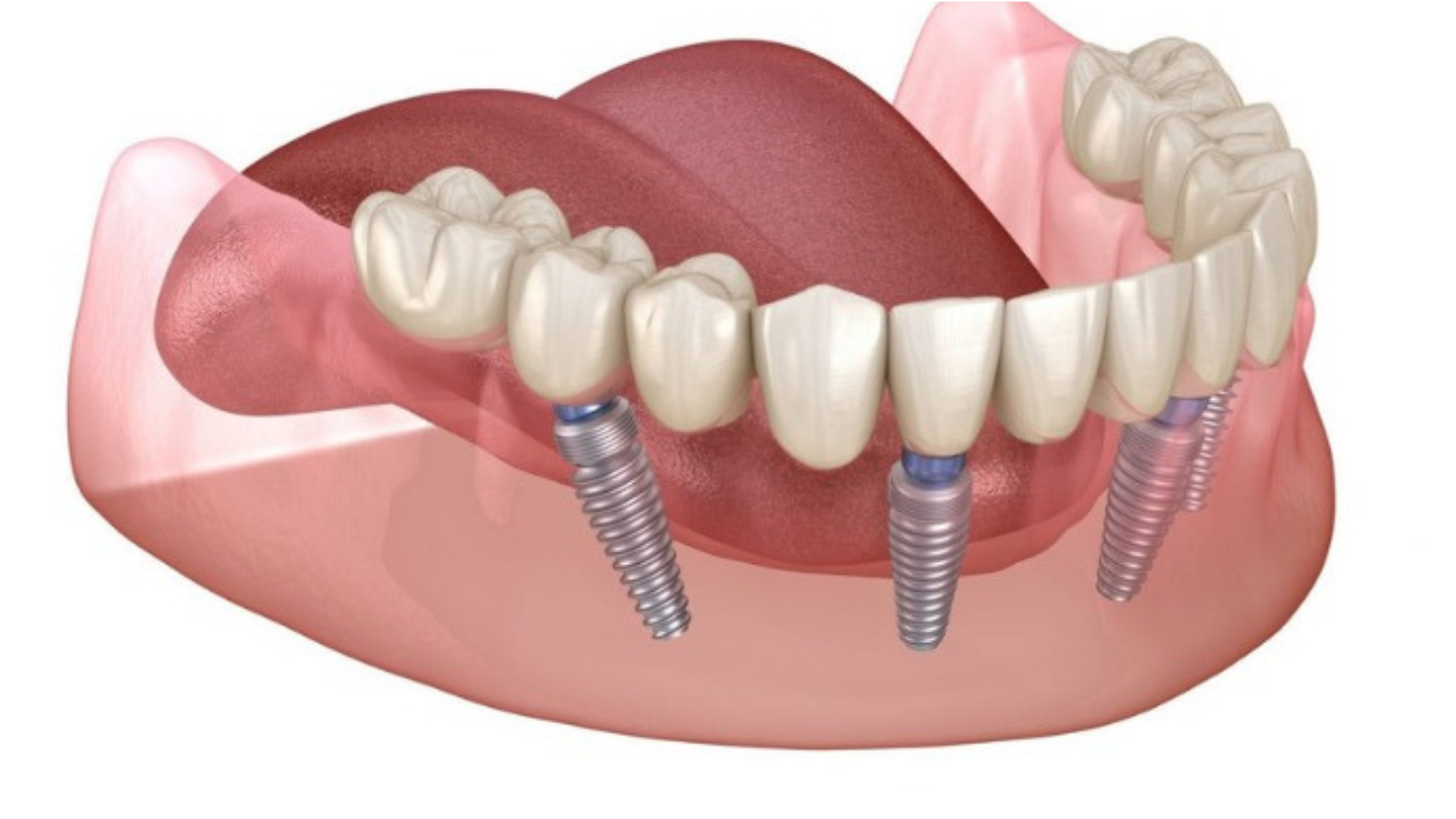 Trồng răng Osstem Implant hiệu quả không?