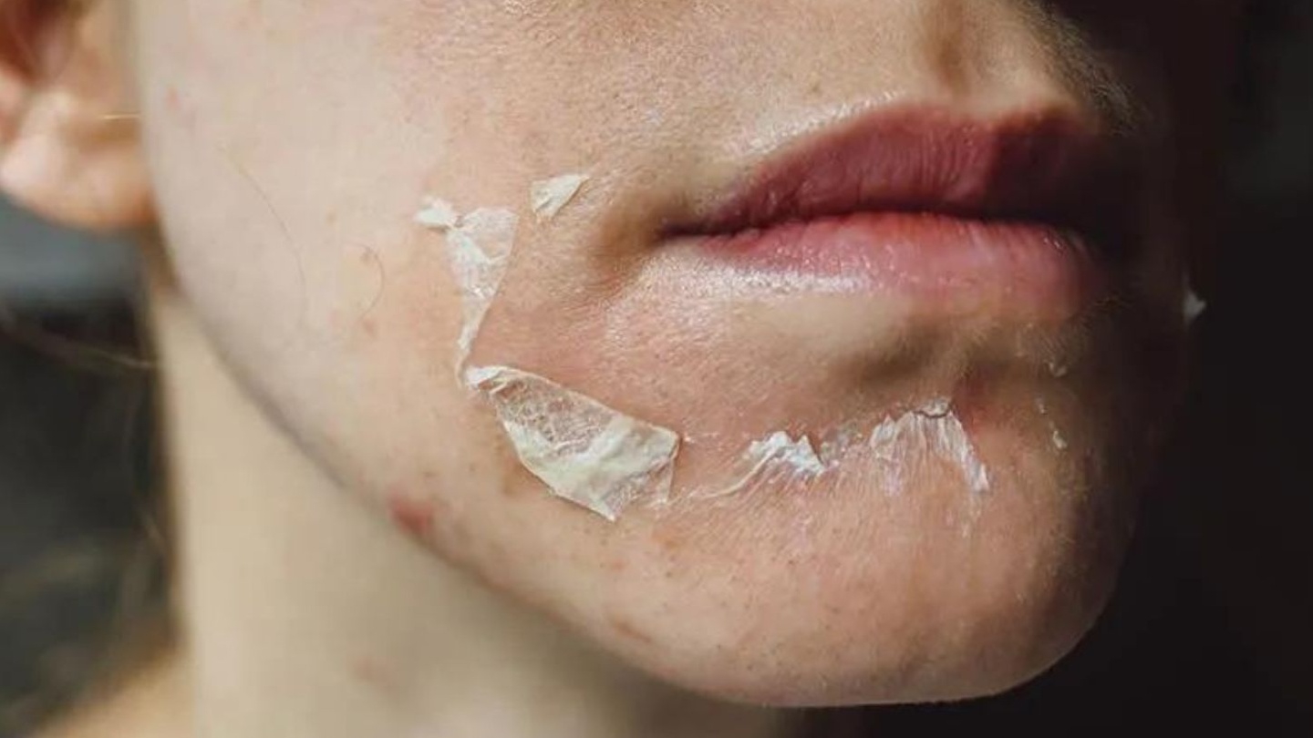 Tìm hiểu chi tiết về phương pháp peel da trị thâm da hiệu quả