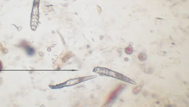 phac-do-dieu-tri-demodex-tang-hieu-qua 1.jpg