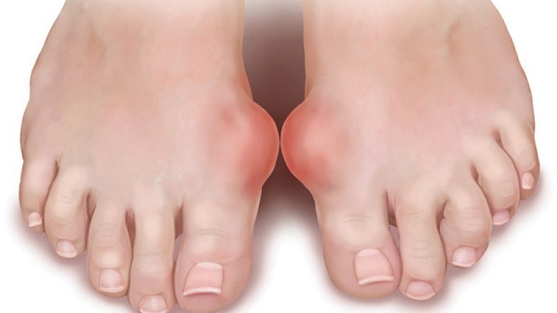 Phân biệt bệnh gout và giả gout: Nguyên nhân, chẩn đoán và cách điều trị