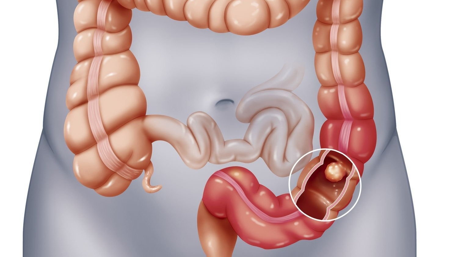 Phân biệt tắc ruột non và tắc ruột già