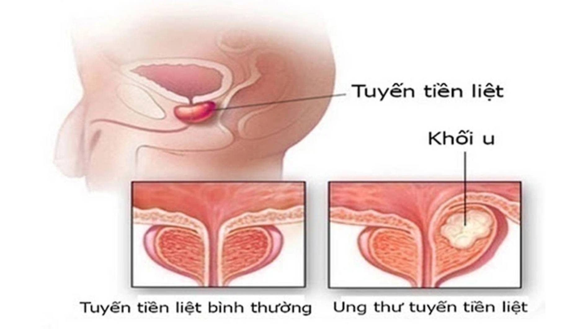 Phát hiện sớm ung thư tuyến tiền liệt