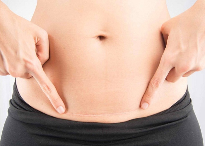 Phẫu thuật tạo hình thành bụng và những điều cần biết 4