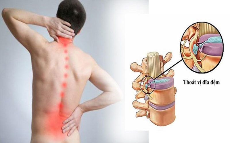 Phẫu thuật thoát vị đĩa đệm cột sống: Các thông tin quan trọng 1