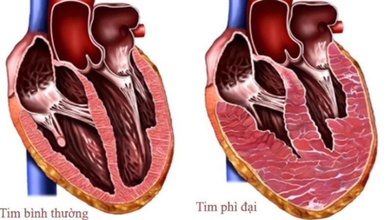 Phì đại thất trái: Nguyên nhâ, triệu chứng, điều trị và phòng ngừa 1