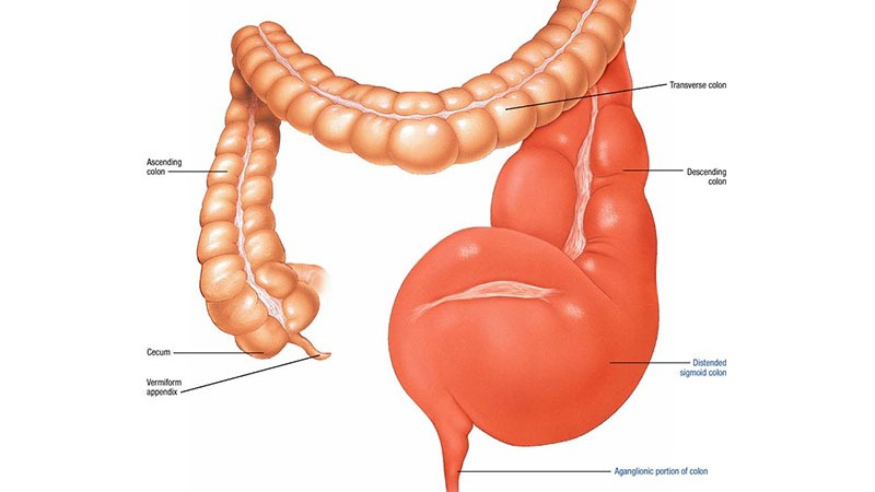 Phình đại tràng: Phương pháp điều trị hiệu quả