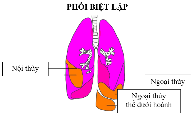 Phổi biệt lập là gì? Triệu chứng, nguyên nhân và phương pháp điều trị 1