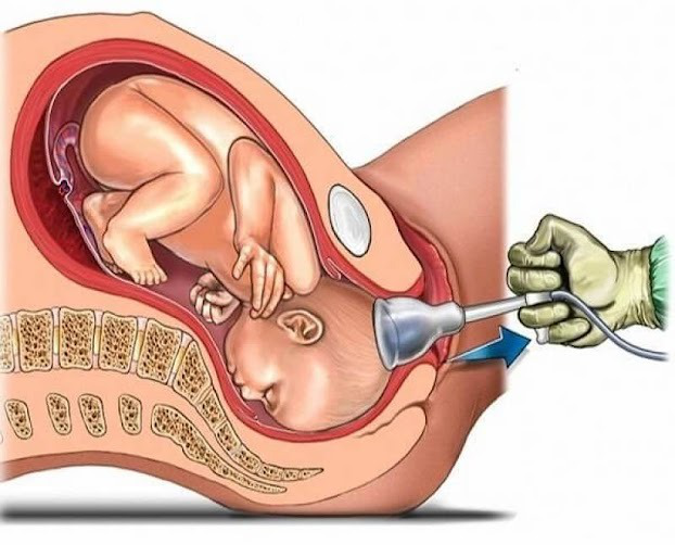 Phụ nữ có nên khâu tầng sinh môn ngay sau khi sinh con? 1