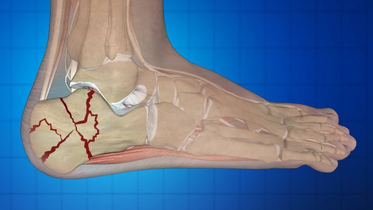 Điều kiện cần thiết để phục hồi hoàn toàn sau gãy xương gót chân là gì?
