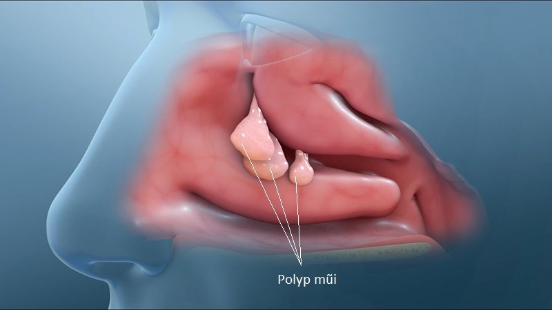 phuong-phap-dieu-tri-polyp-mui-xoang 1.jpg