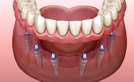Phương pháp trồng răng Implant all on 6 có ưu điểm gì? 3