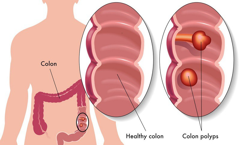 Polyp đại tràng không cuống là gì?