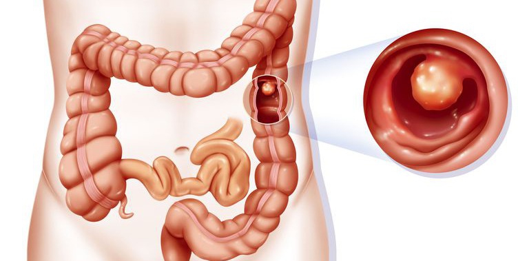 Polyp đại tràng không cuống là gì?