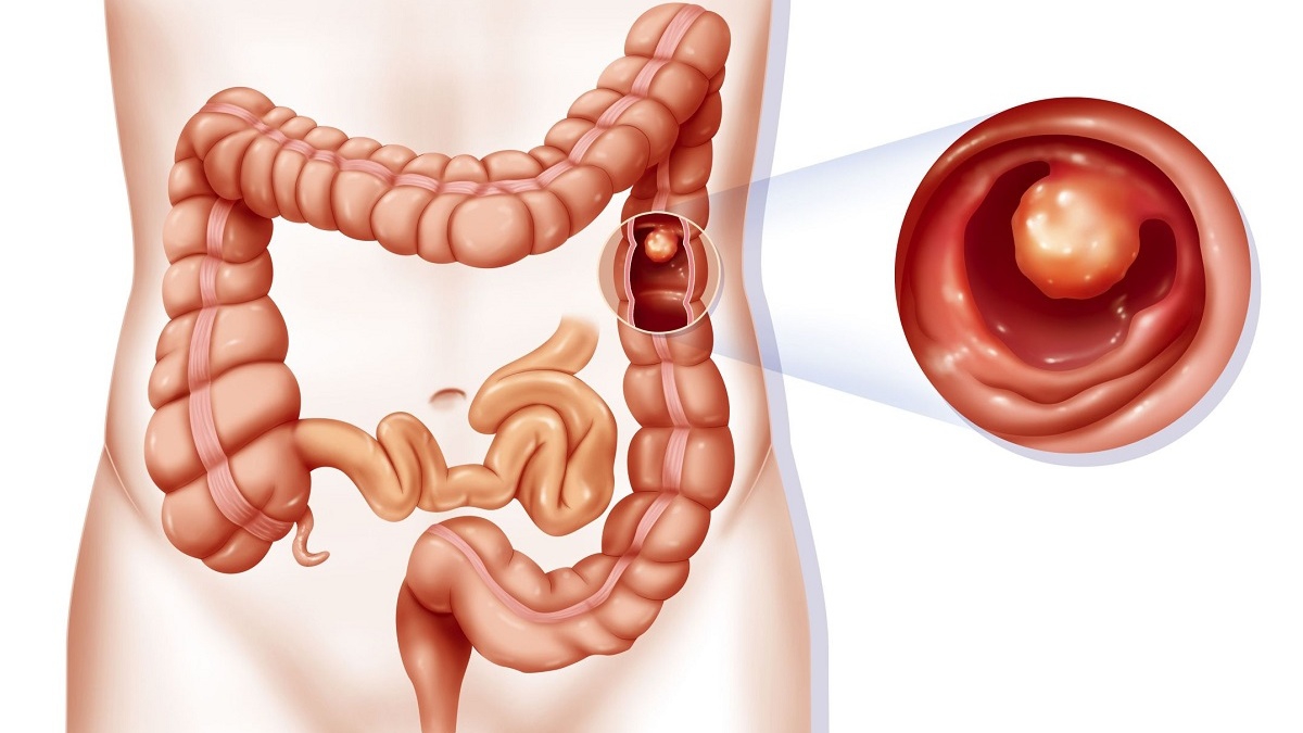 Hội chứng đa polyp gia đình: Thông tin quan trọng bạn nên biết