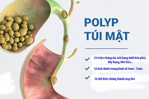 Người bị polyp túi mật kiêng ăn gì để bệnh thuyên giảm? 1