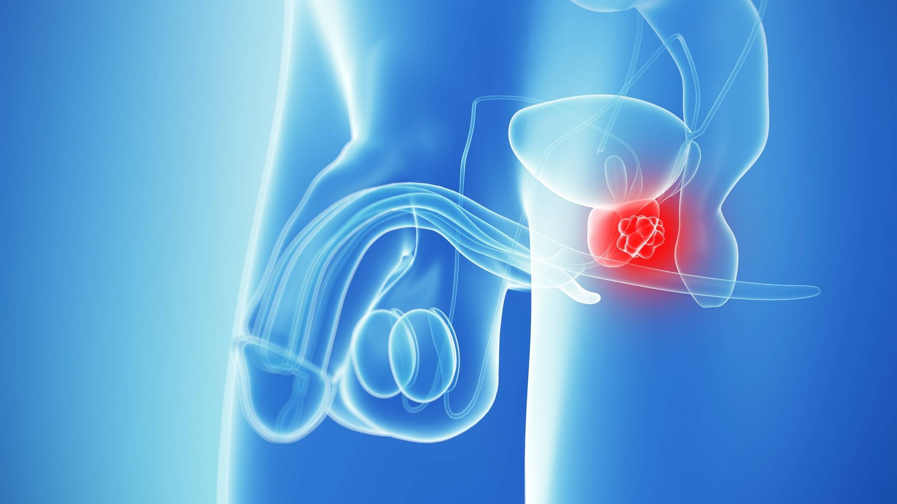 Prostate cancer là gì? Triệu chứng và các giai đoạn của bệnh