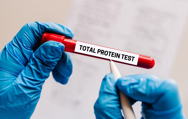 Protein toàn phần là gì? Những điều cần biết về xét nghiệm protein toàn phần 4