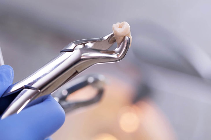 Quá trình mọc răng khôn diễn ra như thế nào? 3