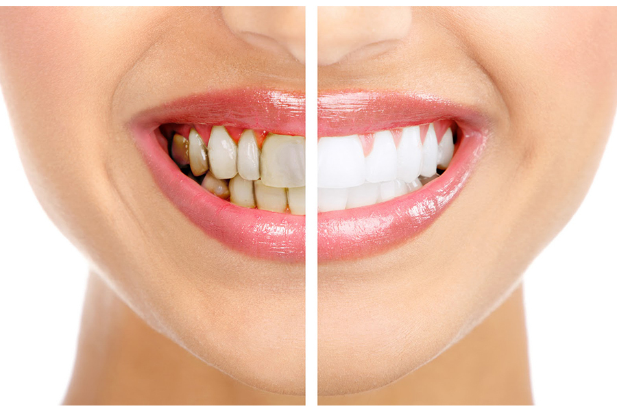 Có cách nào để khắc phục mất màu do răng nhiễm fluor không?
