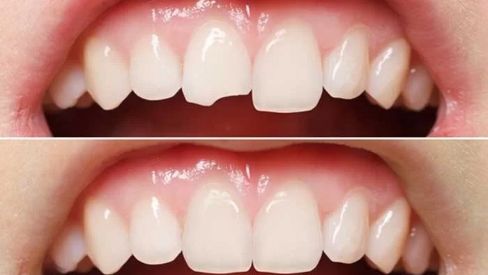 Có phải trám răng cửa bị sâu nặng sẽ làm cho răng yếu hơn không?
