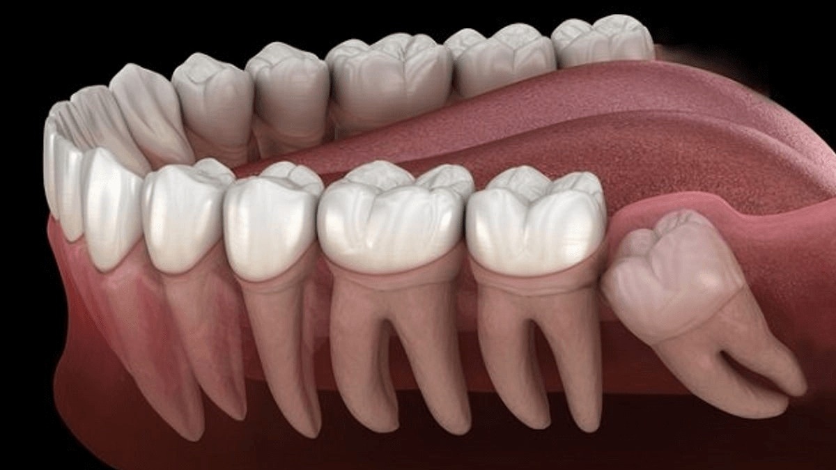 Răng khôn mọc ở đâu trên cung hàm?