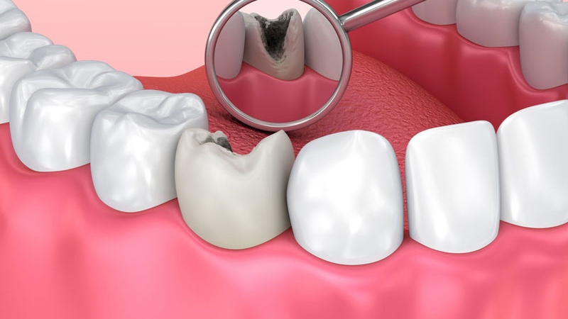 Răng lấy tủy có ảnh hưởng đến sức mạnh của xương không?
