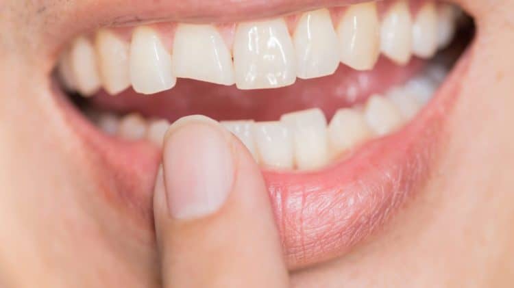 Tại sao răng mẻ bị ê buốt khiến ta gặp khó khăn trong việc ăn uống?

