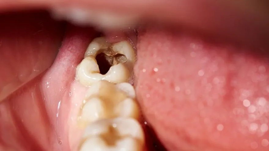 Răng số 7 bị sâu có nên nhổ không? Cách chăm sóc răng miệng để ngăn ngừa sâu răng