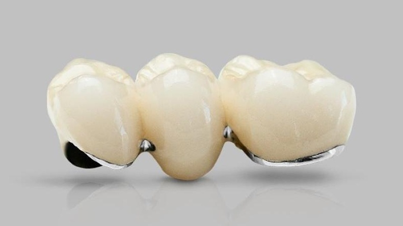 So sánh răng sứ kim loại và răng toàn sứ 1