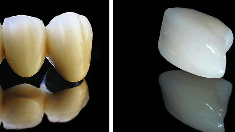So sánh răng sứ kim loại và răng toàn sứ 2